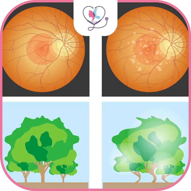 اعتلال الشبكية السكري