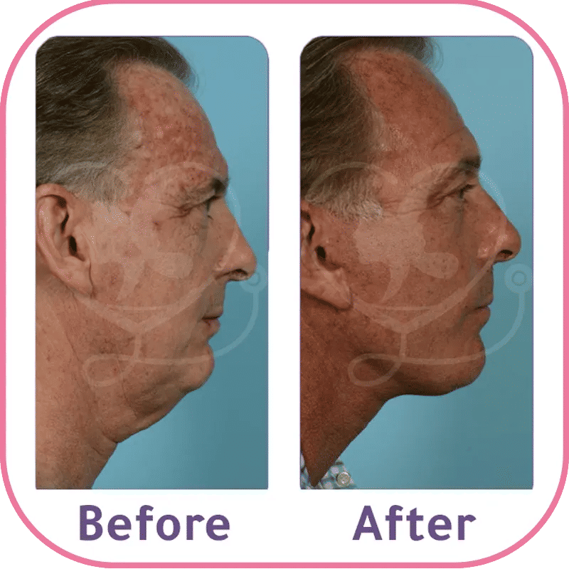 نتائج شد الوجه غير الجراحي للرجال - مقارنة بصرية تظهر اختفاء الترهلات