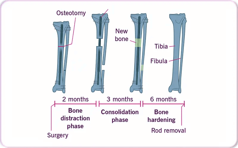 How Does Limb Surgery Work to Increase Height? 2