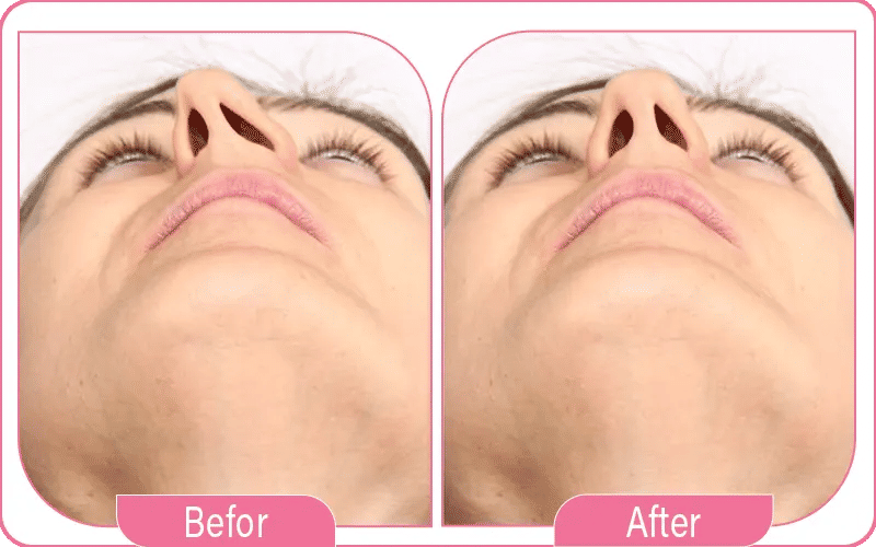 أسباب انحراف الحاجز الأنفي