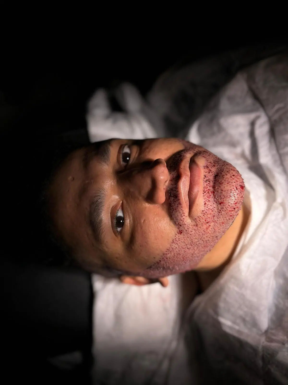 ثانياً: زراعة اللحية تقنية السفير Sapphire - FUE