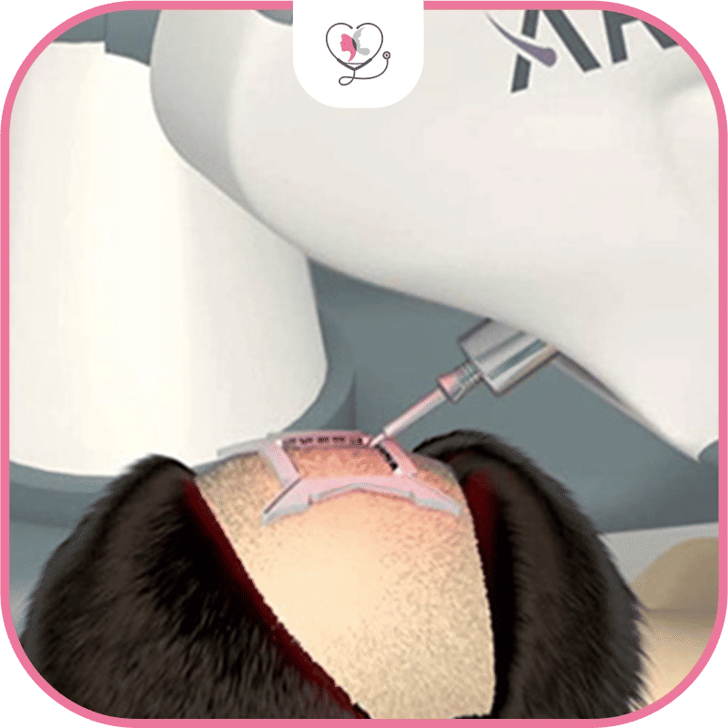  avantages de la robotique dans la greffe de cheveux