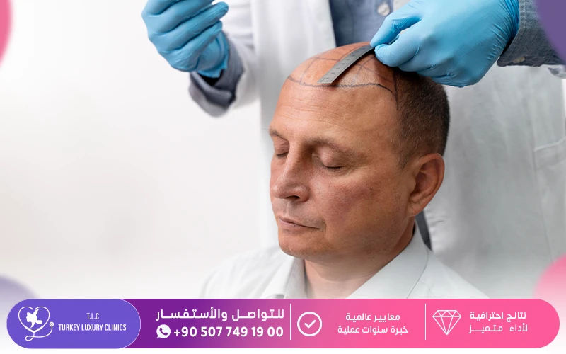 ما هي عملية زراعة الشعر؟
