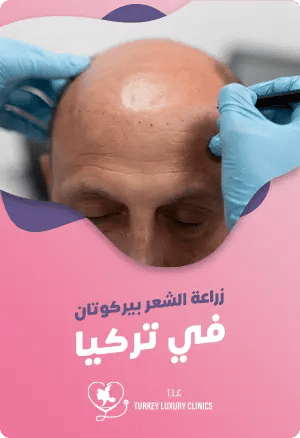 البيركوتان لزراعة الشعر في تركياfeatured image
