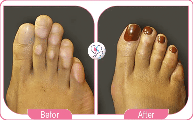 فوائد عملية تجميل أصابع القدم