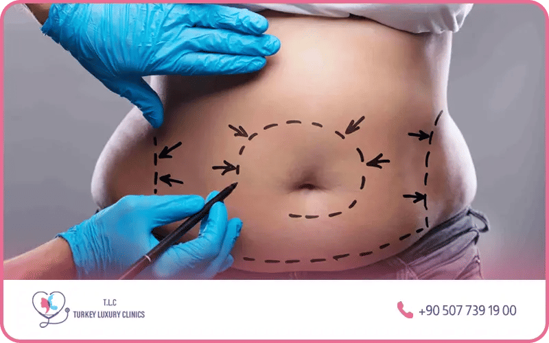 Une abdominoplastie après une sleeve gastrique