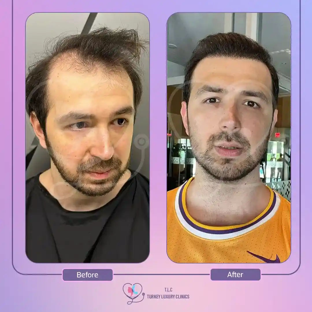 زراعة الشعر في تركيا