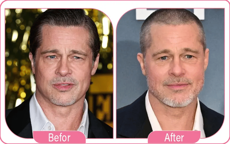 What Do Experts Say About Brad Pitt’s Facelift?