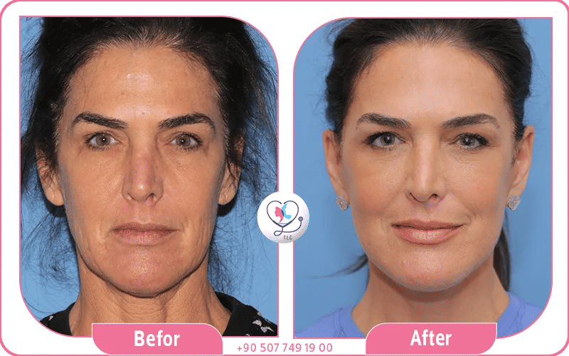 How to Choose the Best Facelift Surgeon in Turkey