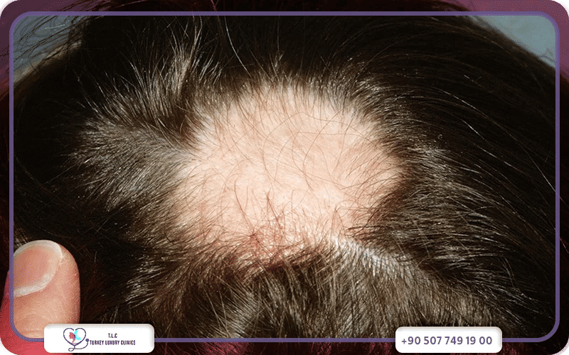 ما هي أسباب الثعلبة؟