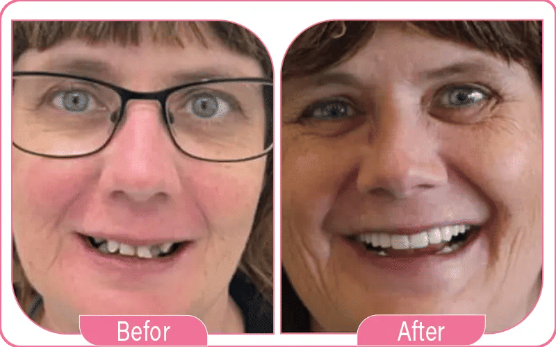 What is a Single Tooth Dental Implant?