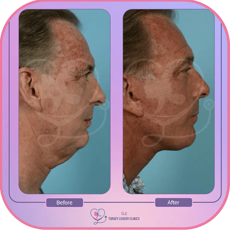 تجربتي مع عملية شد الرقبة في تركيا لاكشري كلينك