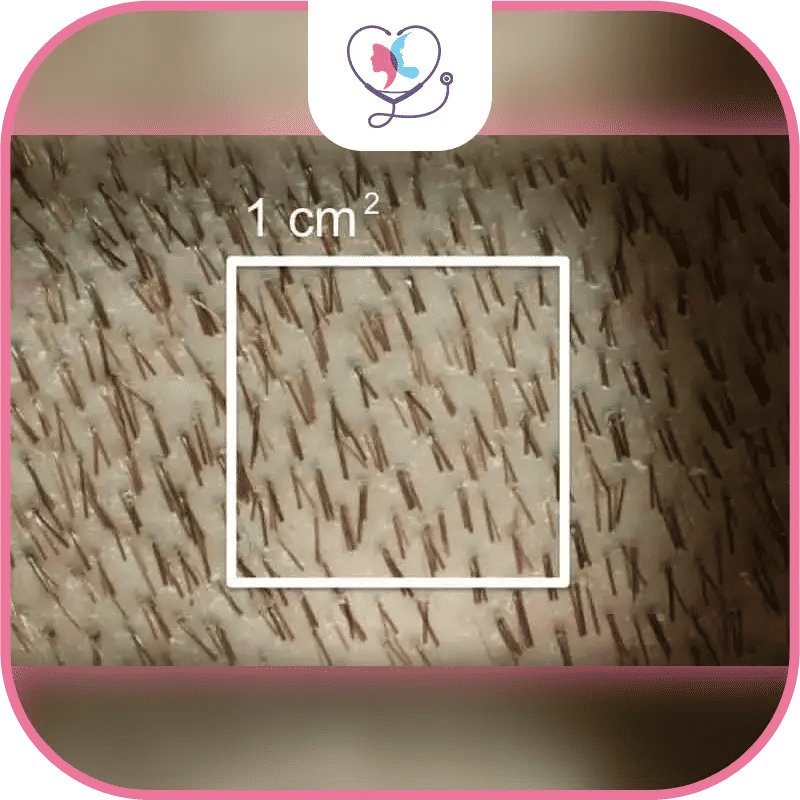 Qu'est ce qu'une densité capillaire après une greffe de cheveux ?