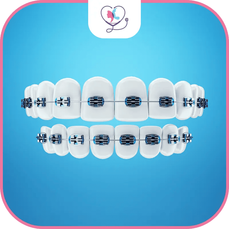 أنواع تقويم الأسنان