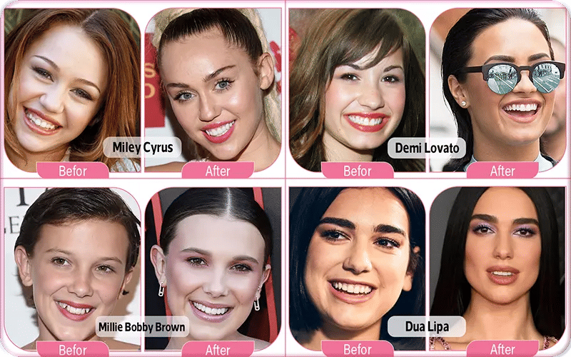 24 Celebrities with Veneers Before & After