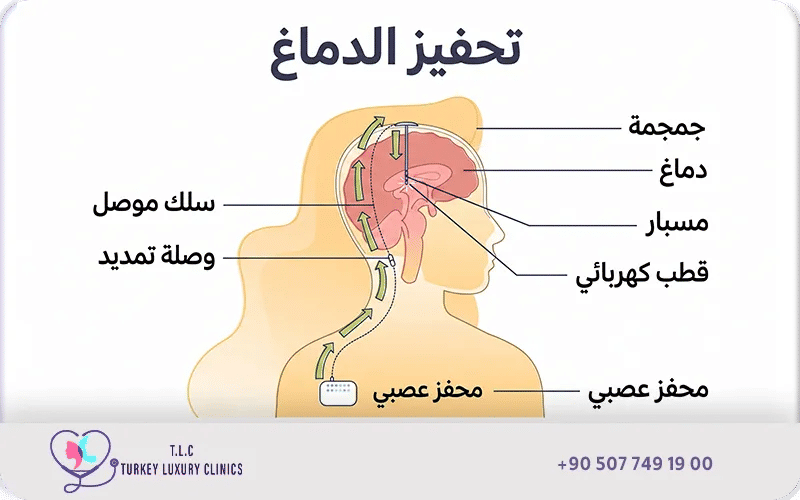 التحفيز العميق للدماغ (DBS)