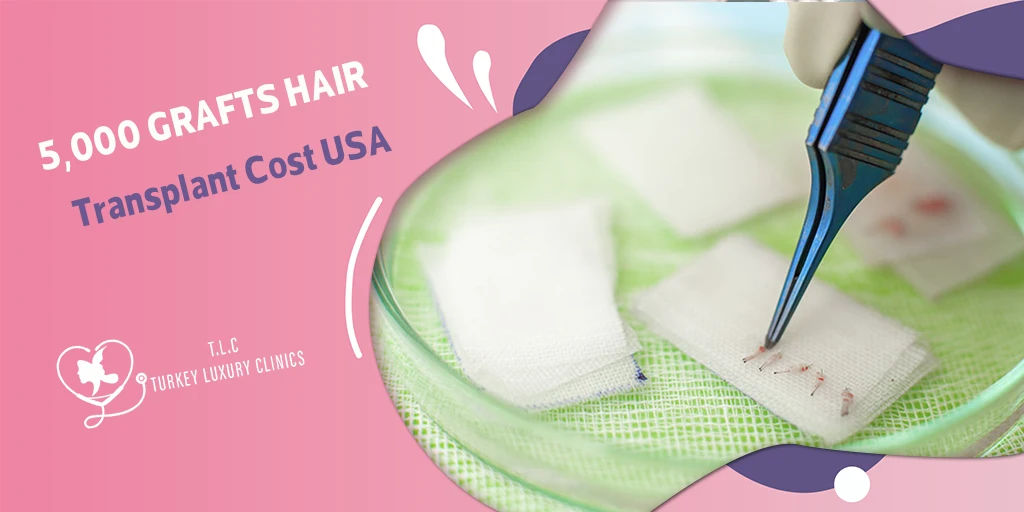 5,000 Grafts Hair Transplant Cost USA: Pricing with Turkey Comparison 2026