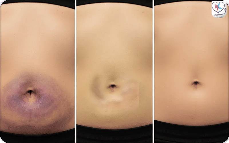 What are Tummy Tuck Belly Button Healing Stages?