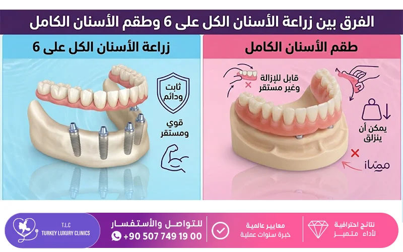 الفرق بين زراعة الأسنان all on 6 وطقم الأسنان