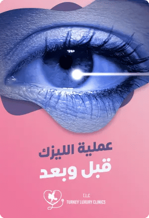 عملية الليزك قبل وبعدfeatured image