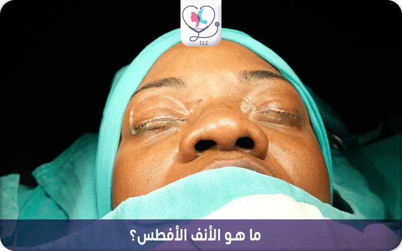 ما هو الأنف الأفطس؟