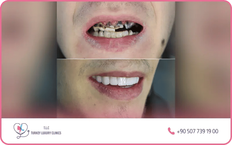 Zirconium crowns uses in Turkey – dental implants, All-on-4, All-on-6, bridges, and full-arch restorations Istanbul