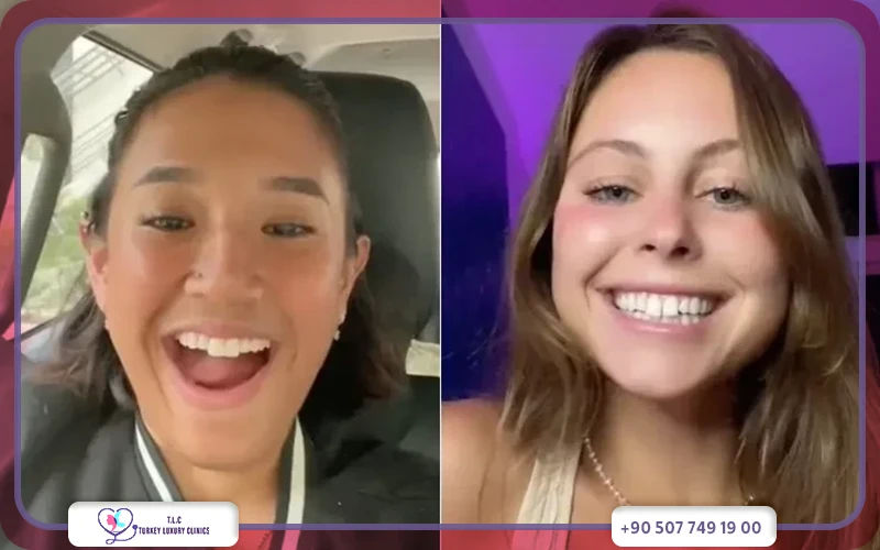 مميزات ابتسامة هوليود أسنان الأرنب مميزات ابتسامة هوليود أسنان الأرنب