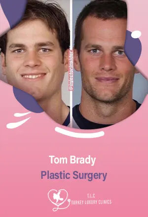 Tom Brady Plastic Surgery: Reverse Aging, Rumors or Truth? Expert Insightsfeatured image