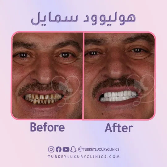 المتابعة بعد تجربتي مع ابتسامة هوليود