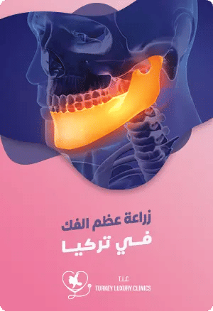 زراعة عظم الفك في تركياfeatured image