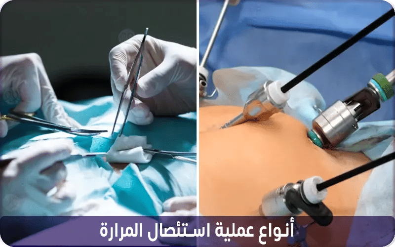 أنواع عملية استئصال المرارة