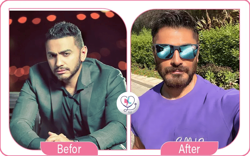 تامر حسني قبل وبعد عملية الفك، ما الذي تغيّر في ملامحه؟