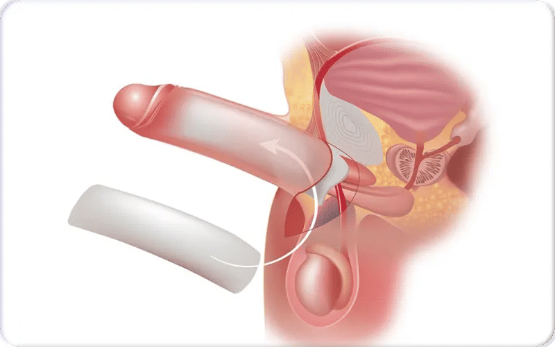Penis Enlargement with Implants