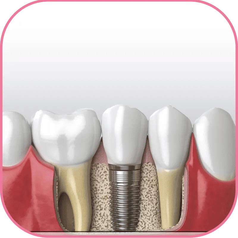 Best Minimally Invasive Dental Implant Techniques