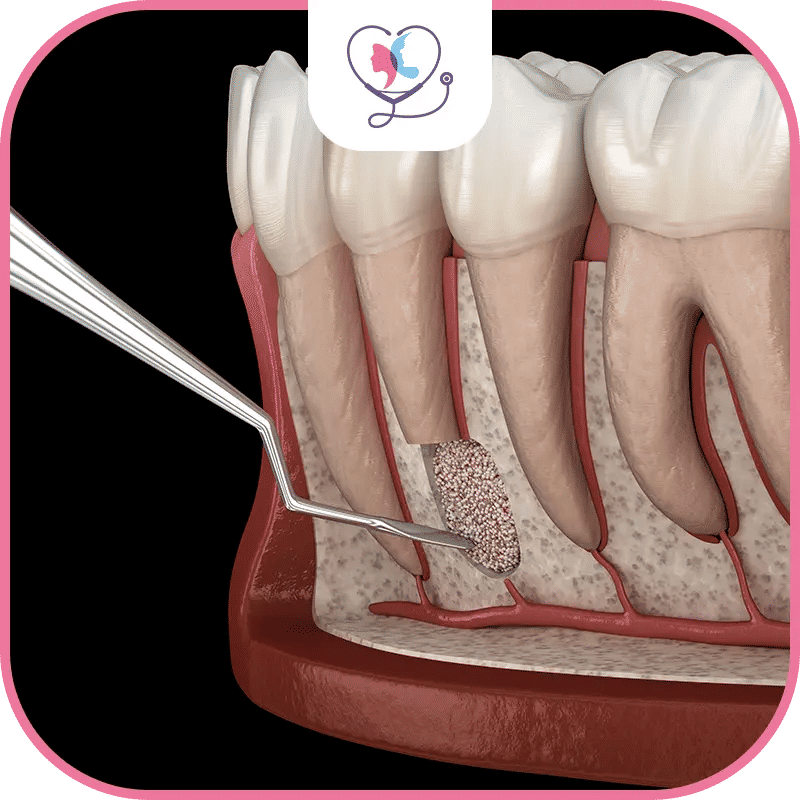 ماهي جراحة دواعم السن في تركيا؟