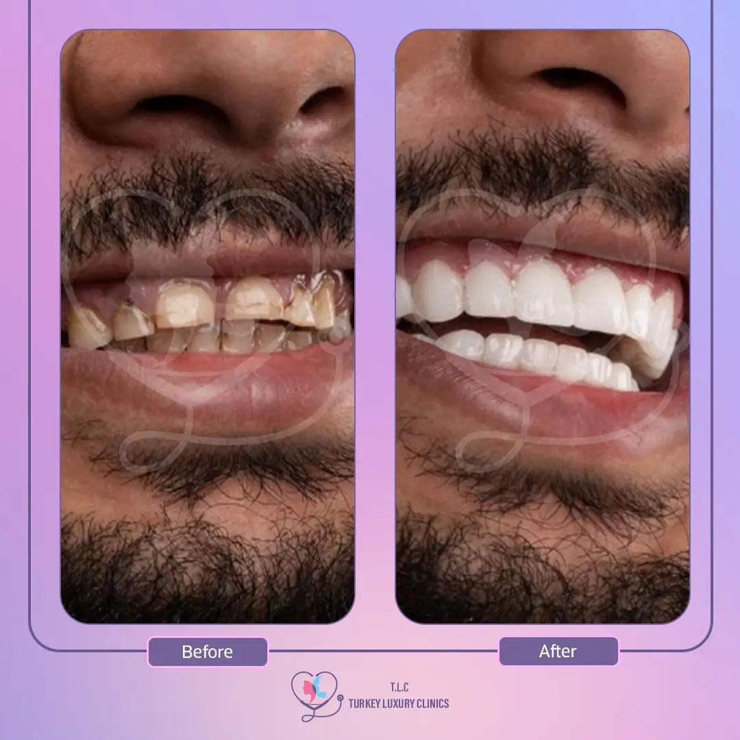 نتائج تبييض الأسنان بالصور قبل وبعد