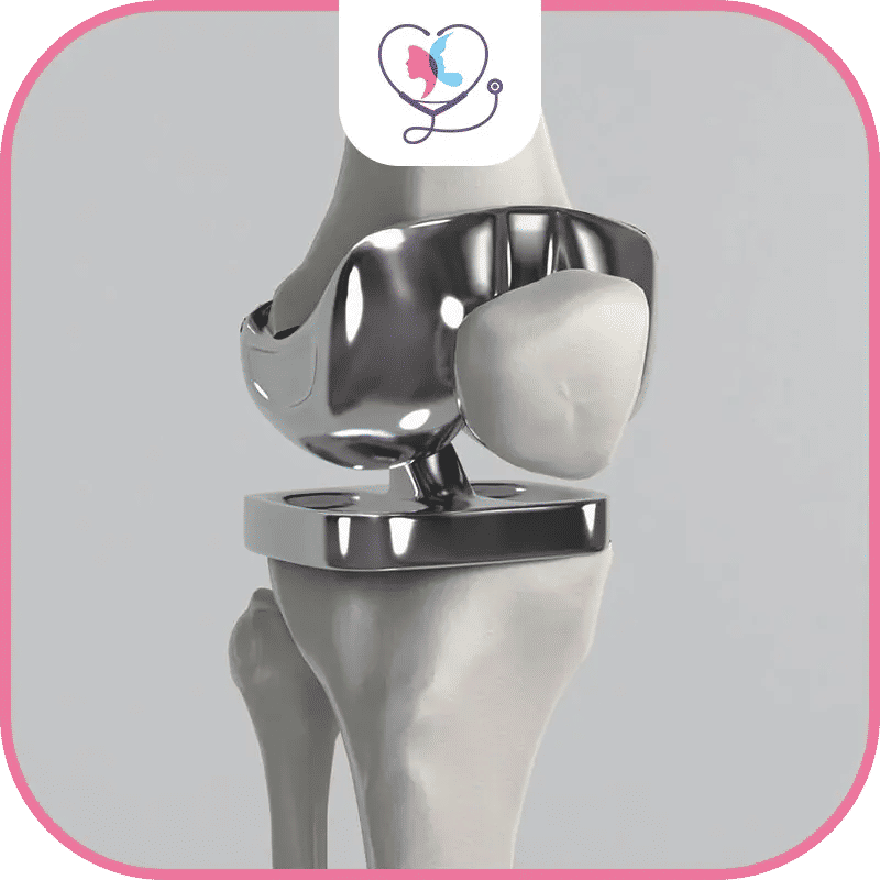 تكلفة عملية تغيير مفصل الركبة في تركيا