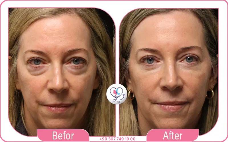 سعر عملية قص الجفون في الدول العربية