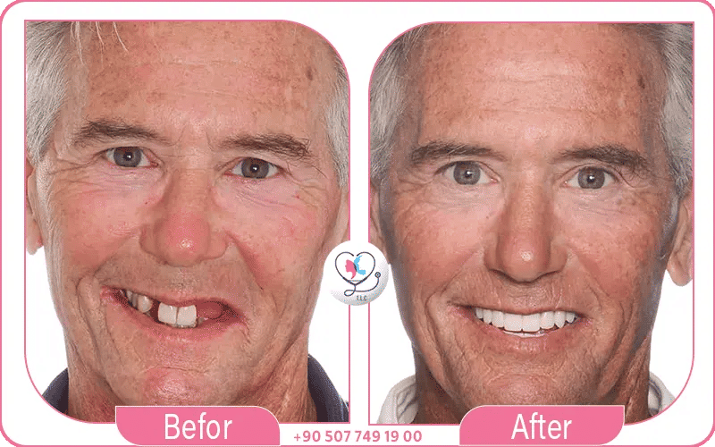 Conseils pour maximiser le résultat avant/après