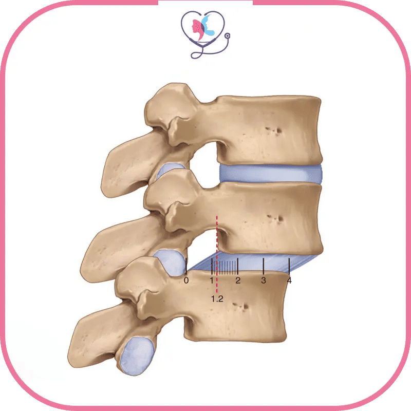 ما هي تكلفة جراحة انزلاق الفقرات في تركيا؟