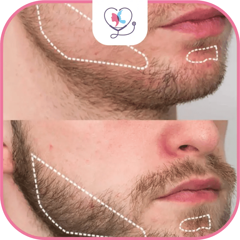 Quelles solutions pour corriger une greffe de barbe ratée ?