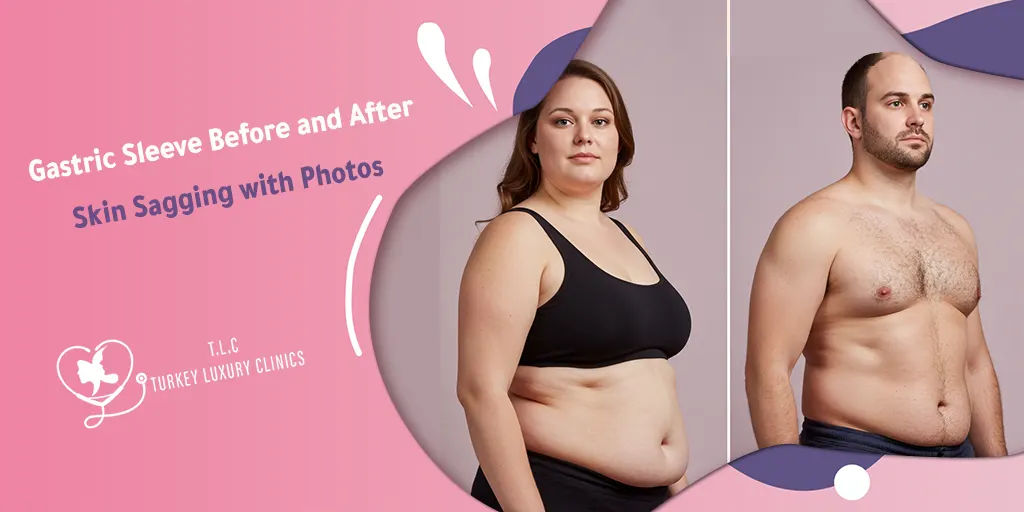 Gastric Sleeve Before and After Skin Sagging with Photos