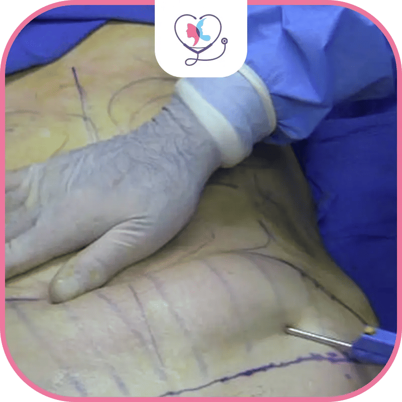 التعافي بعد عملية  نحت عضلات البطن