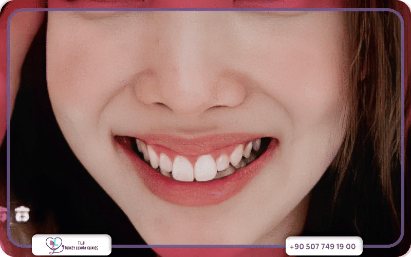 تقنيات الحصول على ابتسامة هوليود أسنان الأرنب تقنيات الحصول على ابتسامة هوليود أسنان الأرنب