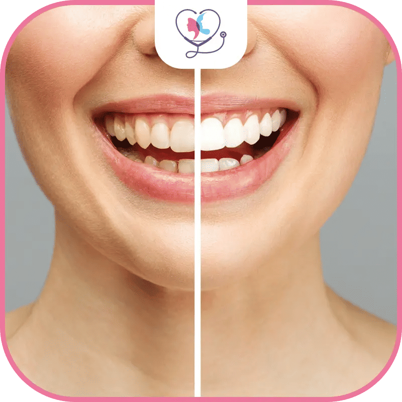 نتائج تبييض الأسنان بالزوم قبل وبعد - مقارنة تظهر اختفاء الاصفرار والتصبغات وظهور أسنان ناصعة البياض بفارق يصل إلى 8 درجات