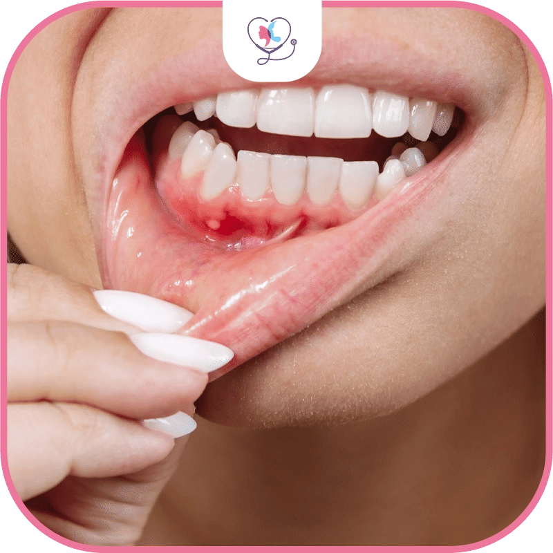 أمراض اللثة