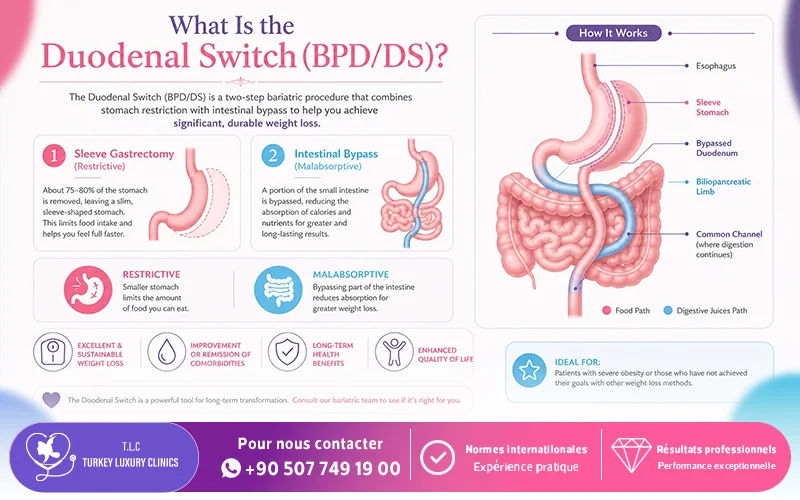 What Is the Duodenal Switch (BPD/DS)?