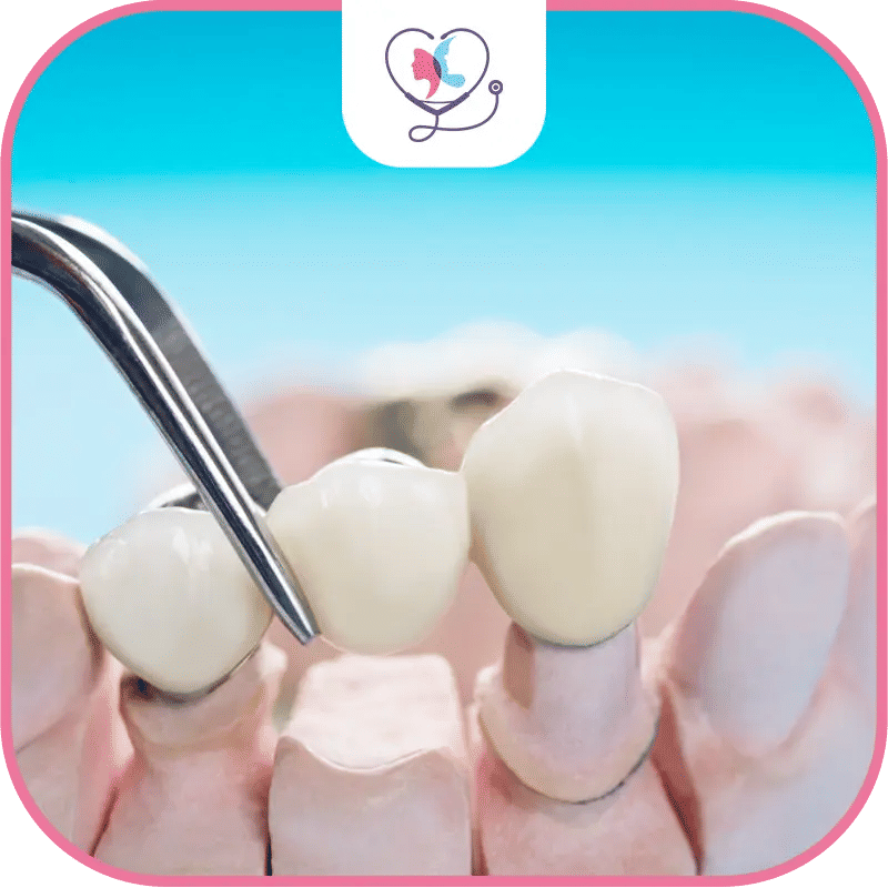 Processus de fixation de couronne dentaire sur racine naturelle