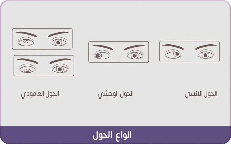 أنواع الحول عند الأطفال