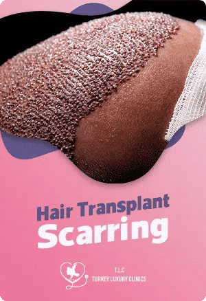 Haartransplantation Narben: Vermeidung und Minimierung